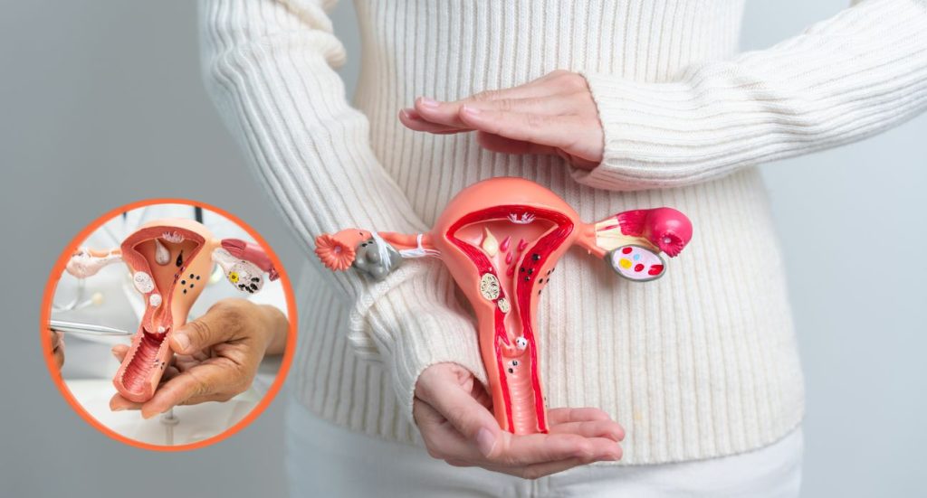 Diagnóstico tardío: el reto para tratar el cáncer de ovario. Foto: Código Salud.