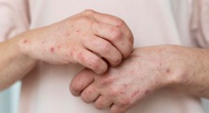El lupus en Colombia: una enfermedad frecuente, pero poco priorizada. Foto: AstraZeneca.